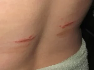 bra skin chafing