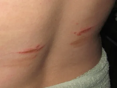 bra skin chafing